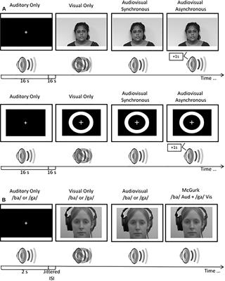 Brain Activation for Audiovisual Information in People With One Eye Compared to Binocular and Eye-Patched Viewing Controls